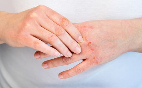 乳膠手套能否有效防止長水泡？